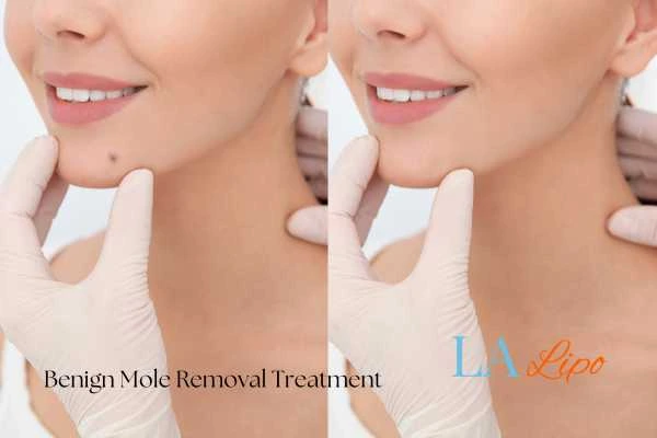 Before-and-after results following benign mole-removal treatment King's Hill