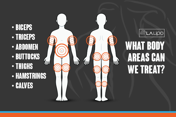 Graphic to show areas you can have LA-EMS Body Sculpting King's Hill treatment.
