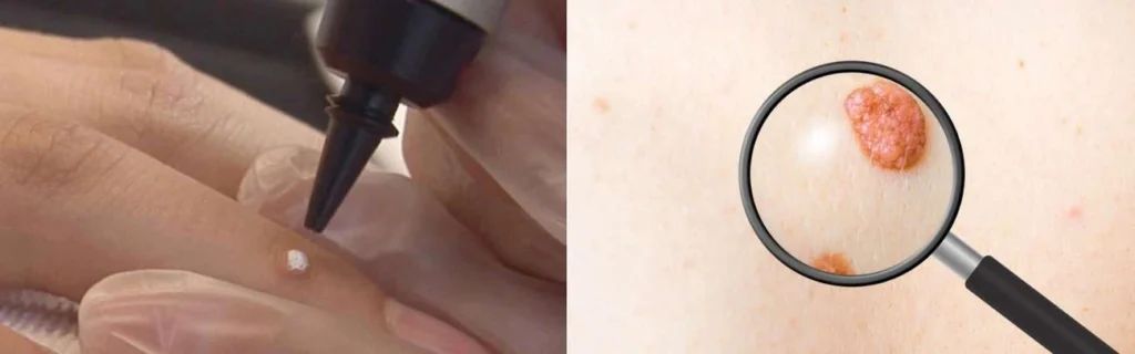 CryoPen practitioner King's Hill assessing a benign mole before treatment