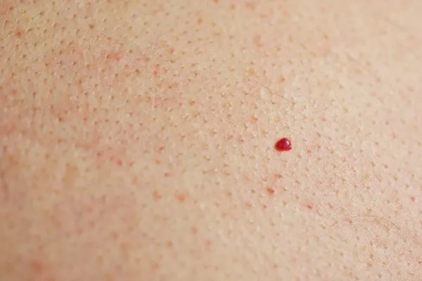 close up of a cherry angioma King's Hill