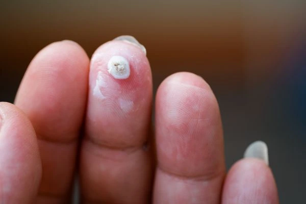 wart on person finger - cryotherapy to treat from LA LIPO King's Hill